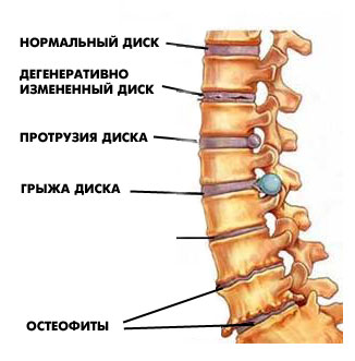 Грыжа L5 S1 лечение | Клиника остеопатической медицины в Москве. | Медицинский центр 